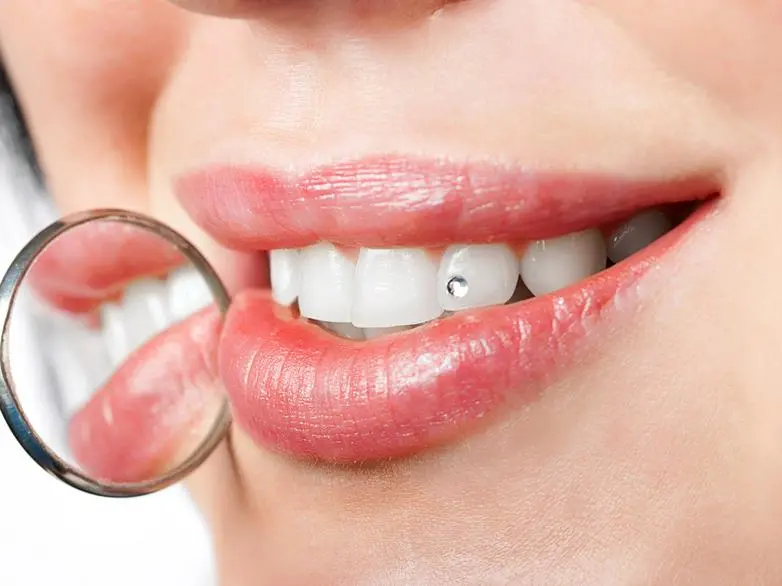 Zahnschmuck - Glamour für Ihr Lächeln