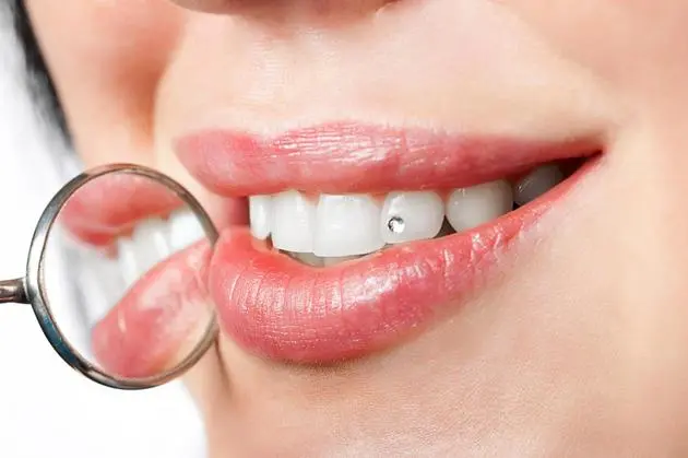 Zahnschmuck – dezent, stilvoll, einzigartig - Ein funkelndes Highlight für Ihr Lächeln