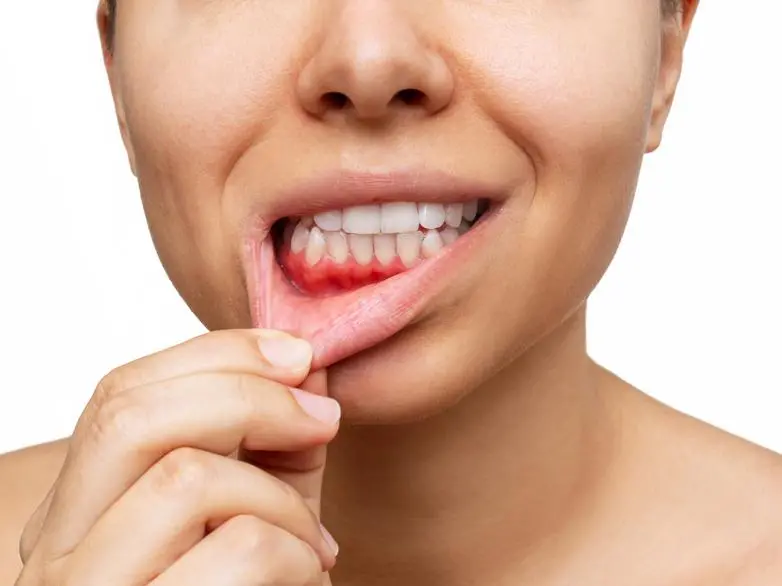 Parodontose, Zahnfleischentzündung und Periimplantitis